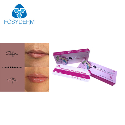 포스이더텀 2 밀리람베르트 피부에 관한 Lip 충전기 히알루론산 Lip 향상 주입 진피 라인
