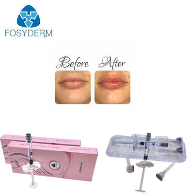 Fosyderm 2ml를 교차합니다 입술 증진을 위한 연결한 Hyaluronic 산 피부 충전물을 교질화하십시오